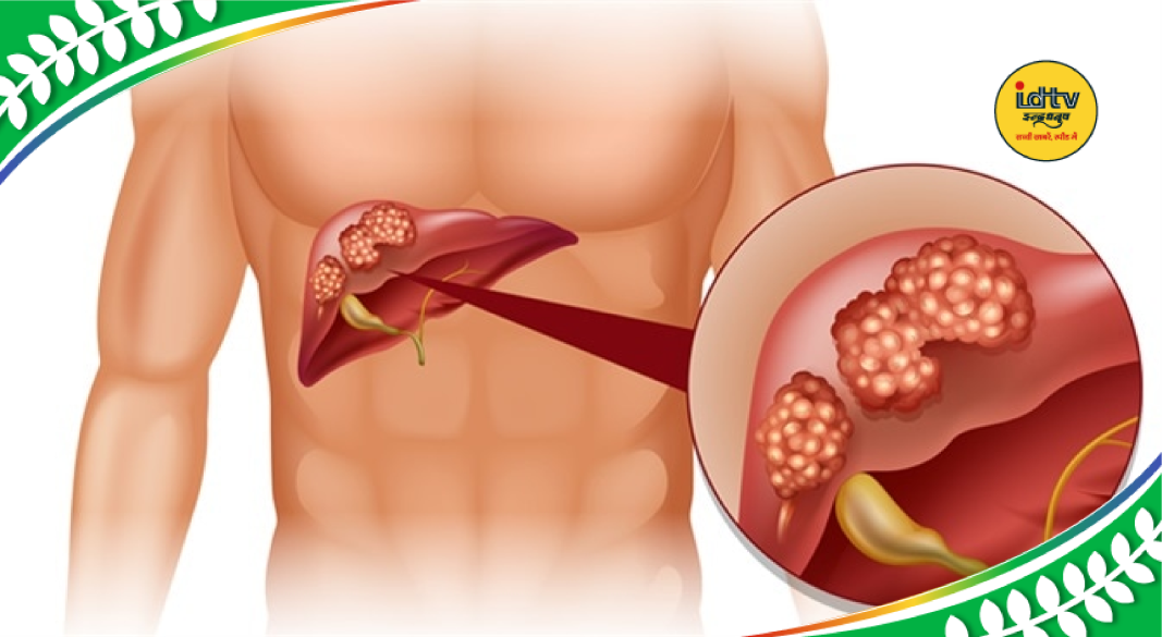 Yellowing eyes and eyelids indicating possible liver disease or early liver cancer symptoms
