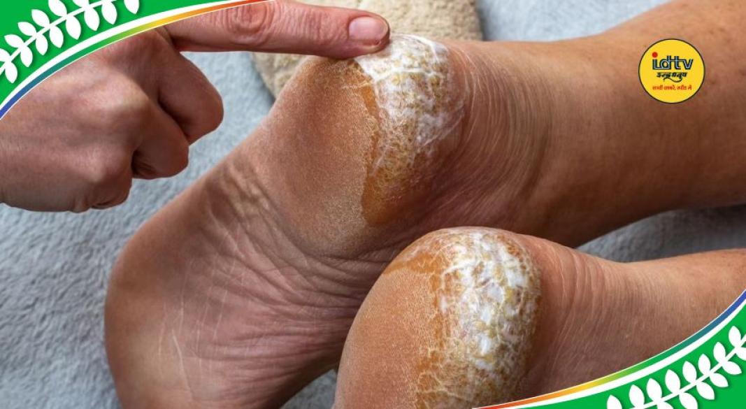 Cracked heels causes