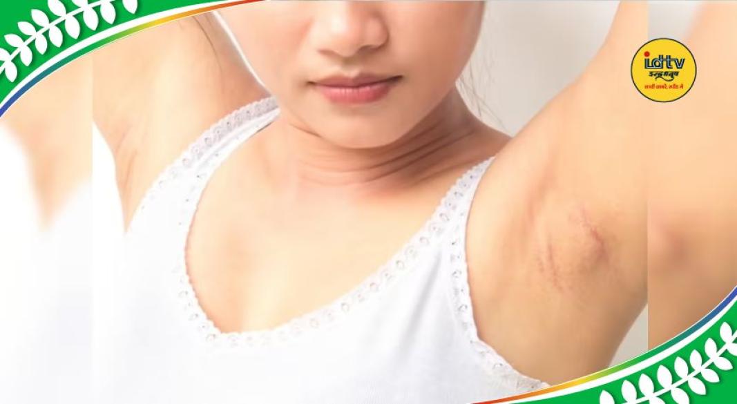 Underarms Darkness Removal